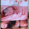 Tranh Treo Tường Y Khoa đường ruột Đại Tràng về polyp đại tràng và dạ dày không chỉ là một tài liệu hữu ích mà còn là một công cụ giáo dục quan trọng